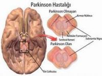 Parkinson hastalığında erken tedavi 