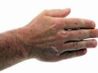 Sedef sadece deriyi etkileyen bir hastalık değil